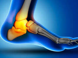 ¿Sufres de fascitis plantar? Descubre por qué las plantillas a medida son la mejor opción